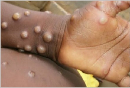 Monkeypox spreads to 26 states in Nigeria